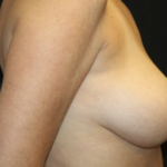 Breast Reduction Before & After Patient #27991