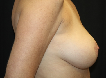 Breast Reduction Before & After Patient #27991