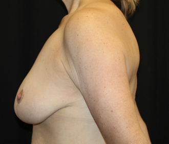 Breast Reduction Before & After Patient #28080