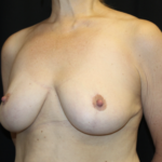Breast Reduction Before & After Patient #28080