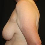 Breast Lift Before & After Patient #28178