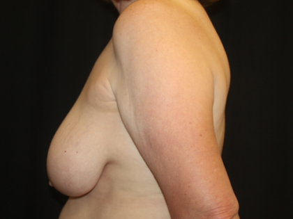 Breast Lift Before & After Patient #28178