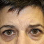 Brow Lift Before & After Patient #28095