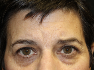 Brow Lift Before & After Patient #28095