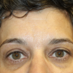 Brow Lift Before & After Patient #28095