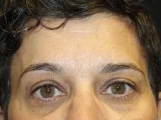 Brow Lift Before & After Patient #28095