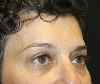 Brow Lift Before & After Patient #28095