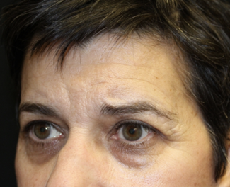 Brow Lift Before & After Patient #28095