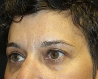 Brow Lift Before & After Patient #28095