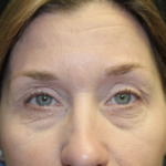 Blepharoplasty Before & After Patient #27855