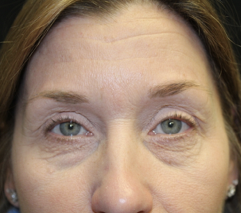 Blepharoplasty Before & After Patient #27855