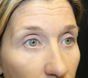 Blepharoplasty Before & After Patient #27855