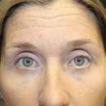 Blepharoplasty Before & After Patient #27855