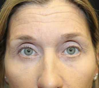 Blepharoplasty Before & After Patient #27855