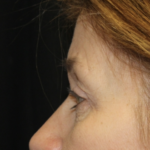 Blepharoplasty Before & After Patient #27855