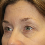 Blepharoplasty Before & After Patient #27855