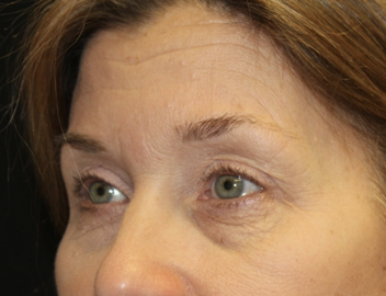 Blepharoplasty Before & After Patient #27855