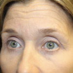 Blepharoplasty Before & After Patient #27855