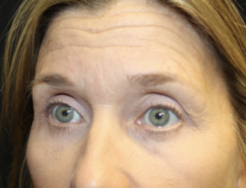 Blepharoplasty Before & After Patient #27855