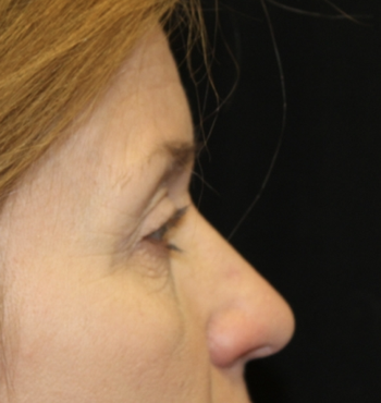 Blepharoplasty Before & After Patient #27855