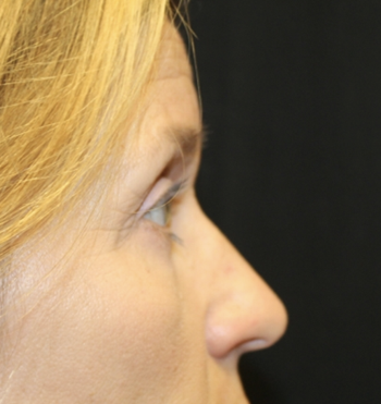 Blepharoplasty Before & After Patient #27855