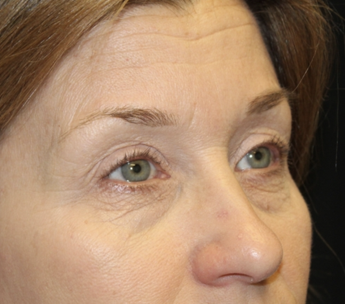 Blepharoplasty Before & After Patient #27855