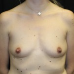 Breast Augmentation - Round Silicone Implants Before & After Patient #27876