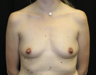 Breast Augmentation - Round Silicone Implants Before & After Patient #27876