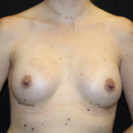 Breast Augmentation - Round Silicone Implants Before & After Patient #27876