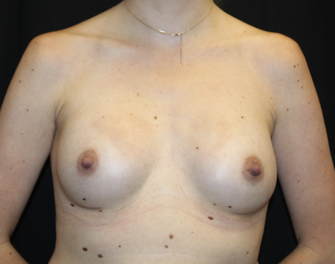 Breast Augmentation - Round Silicone Implants Before & After Patient #27876