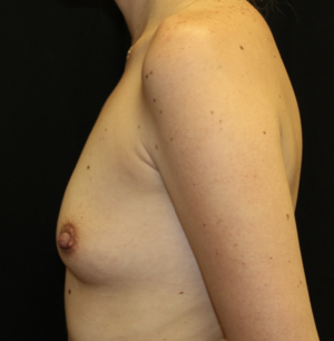 Breast Augmentation - Round Silicone Implants Before & After Patient #27876