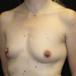 Breast Augmentation - Round Silicone Implants Before & After Patient #27876