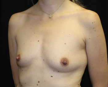 Breast Augmentation - Round Silicone Implants Before & After Patient #27876