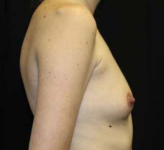 Breast Augmentation - Round Silicone Implants Before & After Patient #27876
