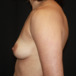 Breast Lift with Implant Before & After Patient #27887