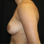 Breast Lift with Implant Before & After Patient #27887