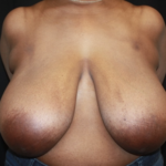 Breast Reduction Before & After Patient #27898