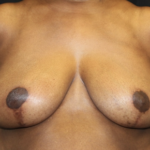 Breast Reduction Before & After Patient #27898