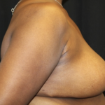 Breast Reduction Before & After Patient #27898