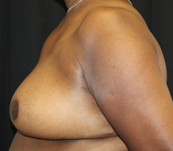 Breast Reduction Before & After Patient #27898