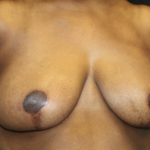 Breast Reduction Before & After Patient #27898