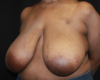 Breast Reduction Before & After Patient #27898