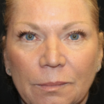 Injectable Fillers Before & After Patient #28002