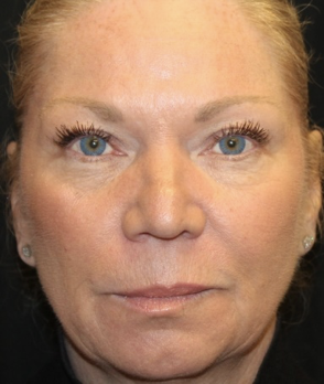 Injectable Fillers Before & After Patient #28002