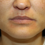 Injectable Fillers Before & After Patient #28191