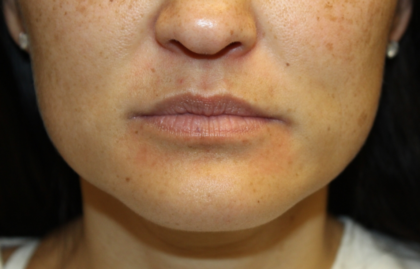 Injectable Fillers Before & After Patient #28191