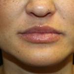 Injectable Fillers Before & After Patient #28191
