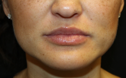 Injectable Fillers Before & After Patient #28191