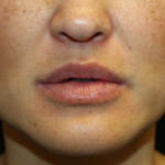 Injectable Fillers Before & After Patient #28191