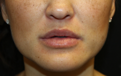 Injectable Fillers Before & After Patient #28191